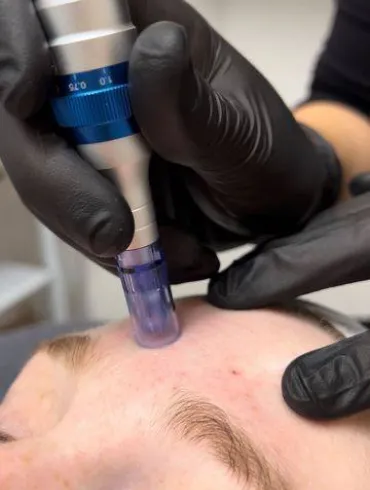 Mesotherapy, DermaPen, glowing skin, anti-wrinkle, hair loss, hair growth