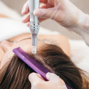 Hair loss, hair growth, mesotherapy, DermaPen, scalp mesotherapy